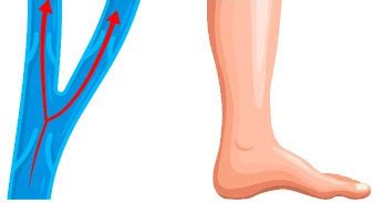 Varicose Veins Treatment - Healic Clinic