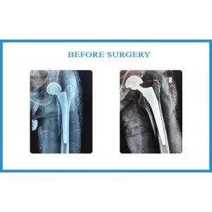 Advanced Knee Replacement Techniques In Vatva - Dr Samir Nanavati