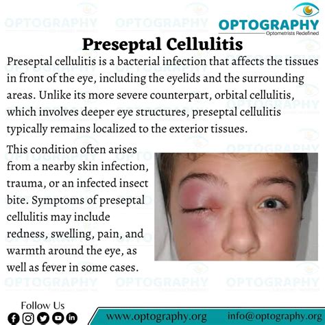 OPTOGRAPHY on LinkedIn: Preseptal cellulitis (sometimes called ...