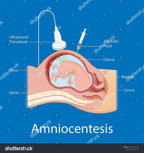 Amniocentesis Procedure