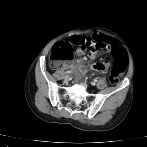 Image result for Perforated Appendix