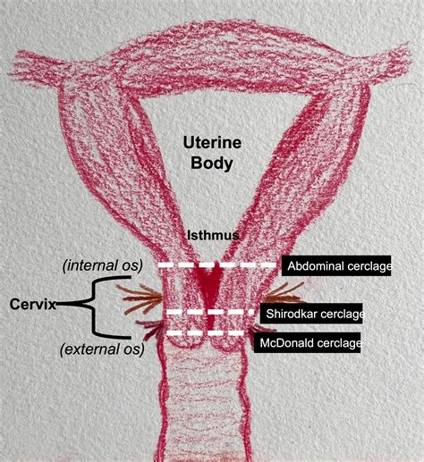 Laparoscopic Abdominal Cerclage - Obstetrics and Gynecology Clinics