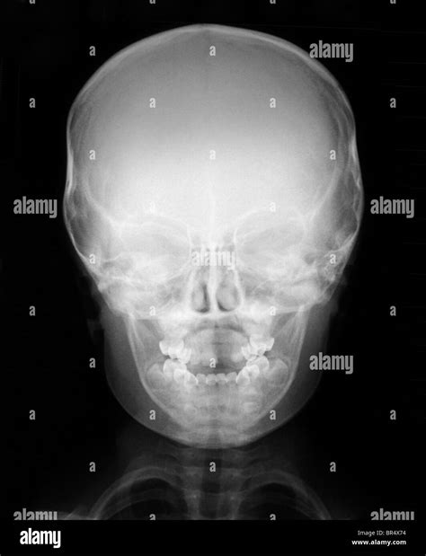 normal x-ray of the head of a 3 year old boy, x-ray of the head and ...