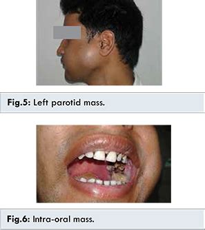 Synovial Sarcoma of the Head and Neck: A Report of 2 Cases