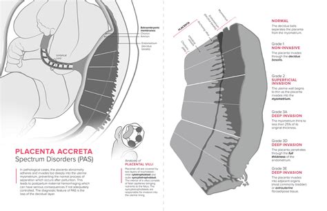 Placenta Accreta Spectrum Disorders on Behance