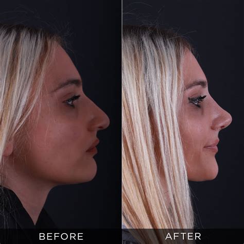 Big and Long Nose Surgery | Dr. Hasan Duygulu