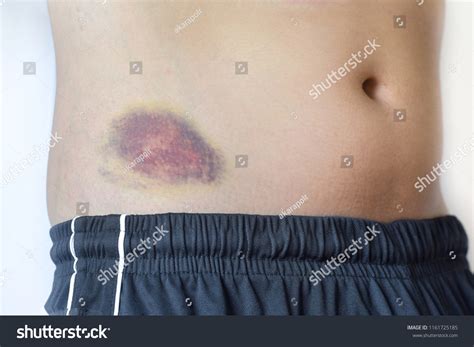 855 imagens de Bruise on stomach Imagens, fotos stock e vetores ...