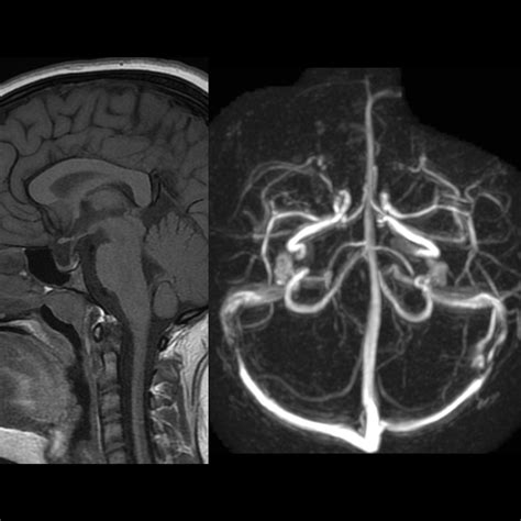Pediatric Empty Sella | Pediatric Radiology Reference Article | Pediatric Imaging | @pedsimaging