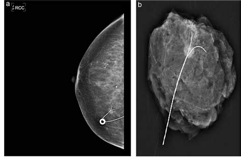 Wire Localization Procedure 的图像结果