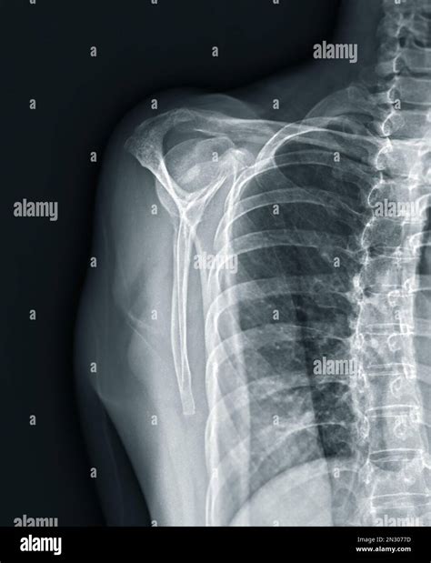 X-ray Shoulder joint shoulder transcapular view for diagnosis fracture ...