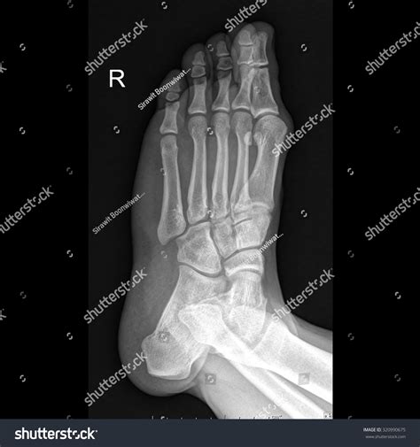 Foot Anatomy X Ray Oblique at Spencer Leschen blog