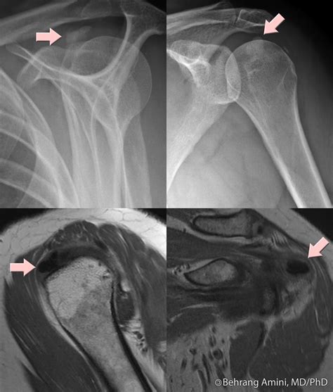 What Causes Calcium Deposits In The Shoulder at Francis Seal blog