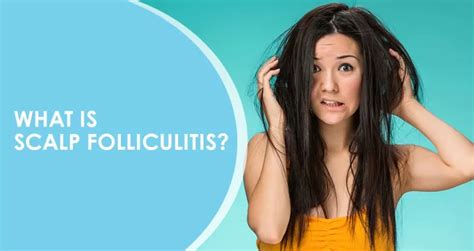 Understanding Scalp Folliculitis: Causes, Symptoms, and Treatment