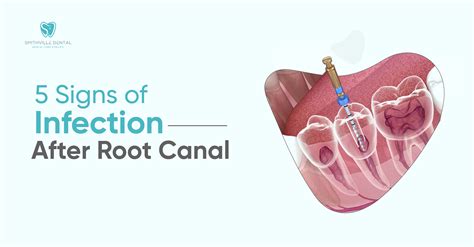 5 Signs of Infection After Root Canal | Smithville Dental