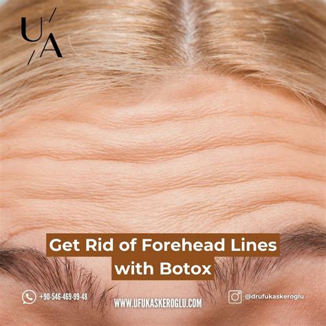 Ways Rid Forehead Lines - Ufuk Askeroğlu