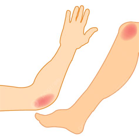 Hand And Leg Pain Sick Knee Bruise Vector, Sick, Knee, Bruise PNG and Vector with Transparent ...