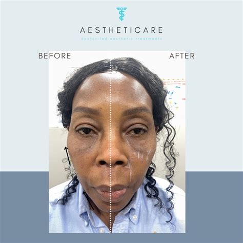 Cheek Fillers & Facial Balancing in Central London | Dermal Fillers