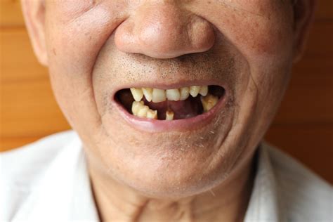 牙不好，影响全身健康！全国爱牙日：成人龋齿患病率90%，专家呼吁关注口腔健康
