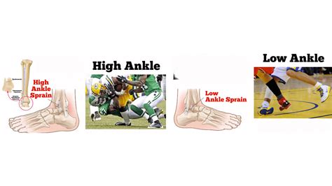 High Ankle Sprain Recovery Time: What to Expect - My Fitness Yoga