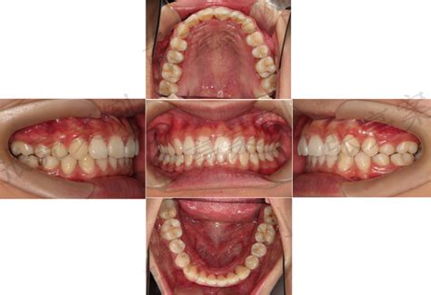 看牙记：记录一下在杭州拔牙补牙和洗牙的经历，杭口和省口~杭州想看牙的小伙伴们可以参考一下 - 知乎