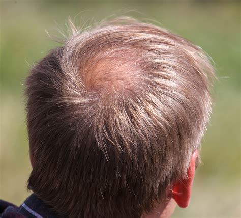 Signs of balding you should watch out for - myhair