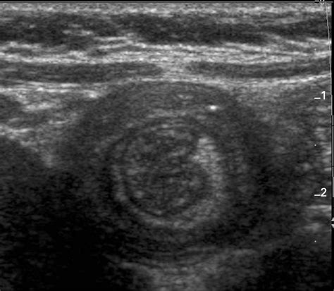 Imaging and intussusception | ADC Education & Practice Edition