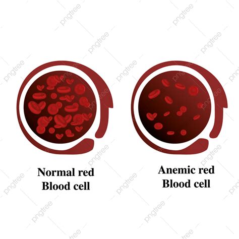 Anemia Ferro Ilustração Vetorial Médica De Glóbulos Vermelhos PNG ...