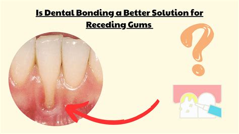 Is Dental Bonding a Better Alternative to Gum Grafting?