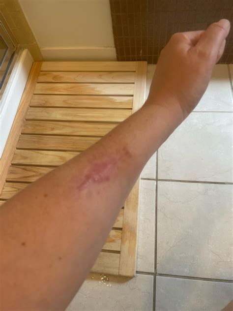 Scar from Wide Local Excision. Looks like a shark bite to me. Pretty ...
