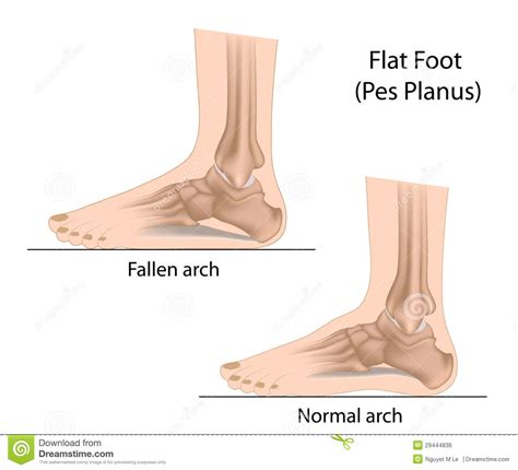 What Is Flat Feet? - By Dr. Radhika Amulraj | Lybrate