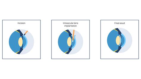 What is Lens Replacement Surgery? Your Lens Surgery Guide.