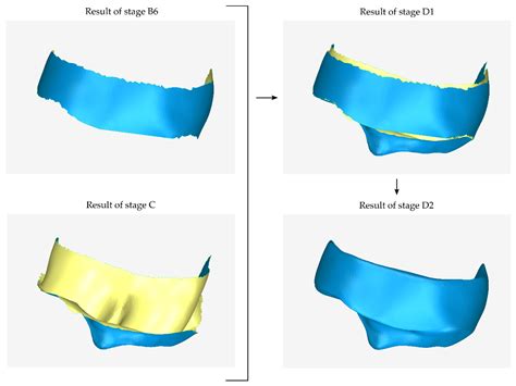 CBCT-Based Design of Patient-Specific 3D Bone Grafts for Periodontal ...