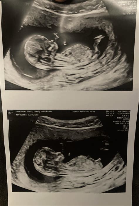 13 Weeks Ultrasound