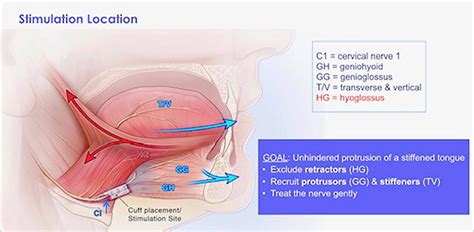 First UK hypoglossal nerve stimulation implant in the treatment for ...