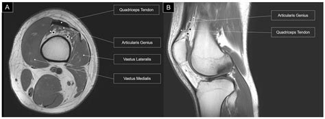 Ultrasound Imaging of the Articularis Genus Muscle: Implications for ...