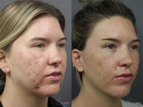 Acne: Laser Treatment Before & After Gallery: Patient 1
