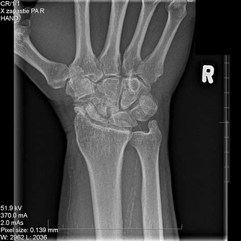 SNAC (Scaphoid Nonunion Advanced Collapse) - Hand - Orthobullets