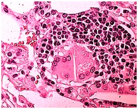 Does Cannabis Smoke Cause Interstitial Lung Disease?