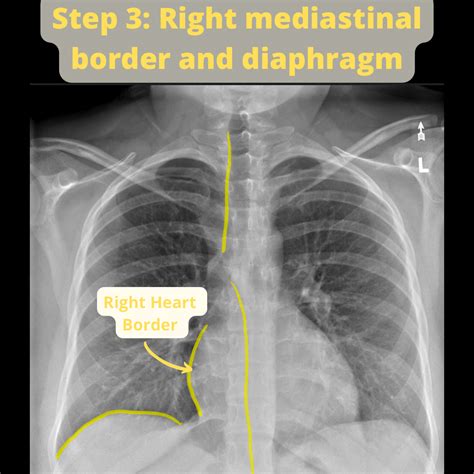 How to Read a Chest X-ray – Radiology for Newbs