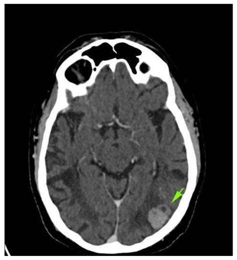 Type I Diabetes—A Rare Adverse Event Described in Patients Receiving ...