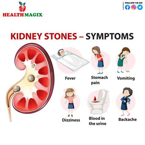 Kidney Stones – Symptoms - Heath Magix