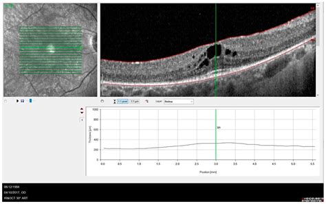 Retinal Dystrophies Associated with Mutations in the RP1 Gene: Genotype ...