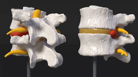 Stand with Herniated Spinal Vertebrae 3D | 3D Molier International