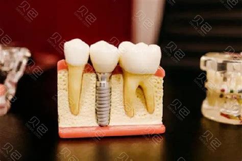 嫌种牙的价格贵?那是你不了解影响一颗种植牙费用的内情 牙科行业资讯 - 口腔新资讯 - 牙齿矫正网