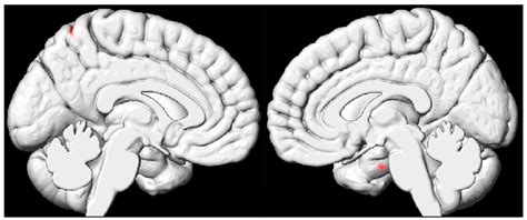 Microstructural Analysis of Whole-Brain Changes Increases the Detection ...