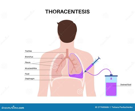 Thoracentesis Anatomy