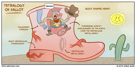 Tetralogy of Fallot | MedComic