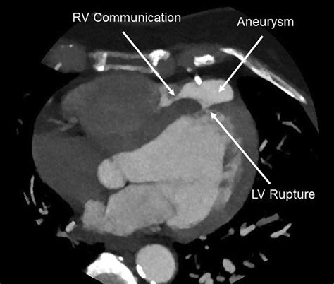 Left Ventricular Aneurysm Perforating into the Right Ventricle: A Rare ...