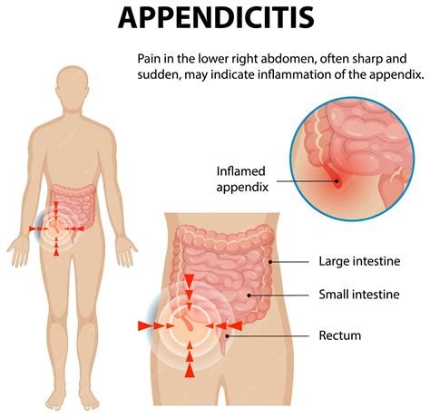 Comprendre l'appendicite et les douleurs abdominales | Vecteur Gratuite