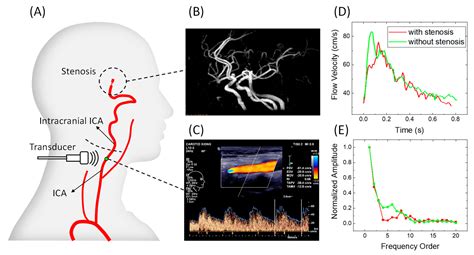 Early Diagnosis of Intracranial Internal Carotid Artery Stenosis Using ...